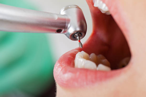 Best Emergency Wisdom Teeth Removal in St Francisville, LA